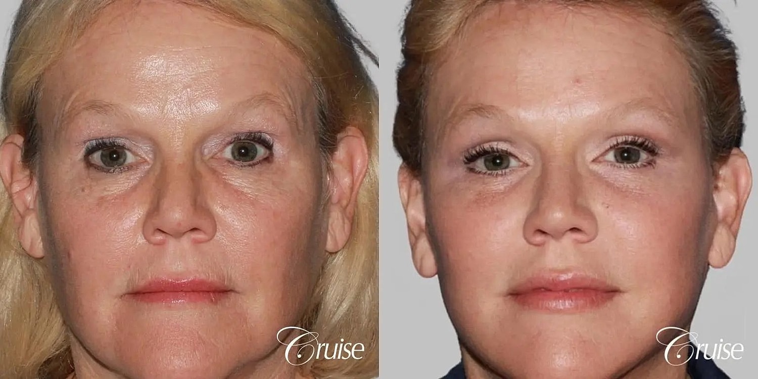 Facial Fat Transfer Before & After