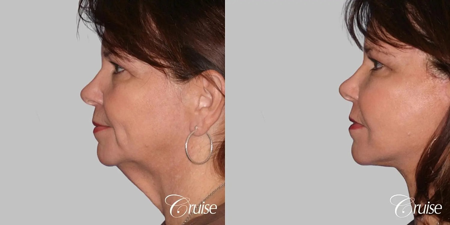 Facial Fat Transfer Before & After