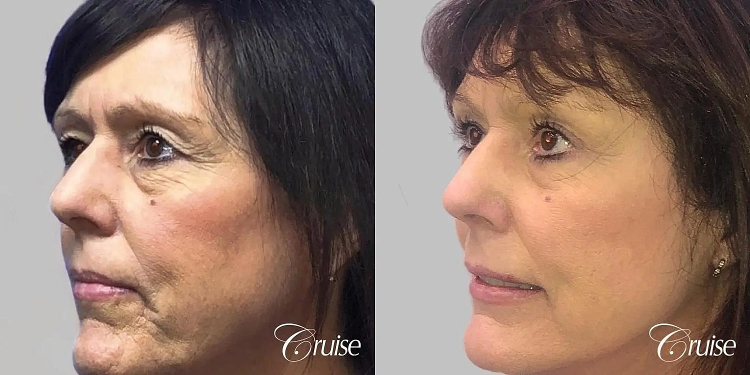 Facial Fat Transfer Before & After