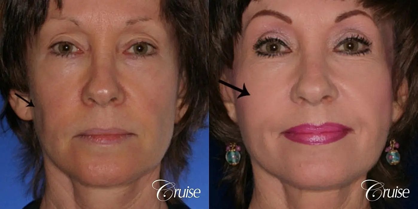 Facial Fat Transfer Before & After