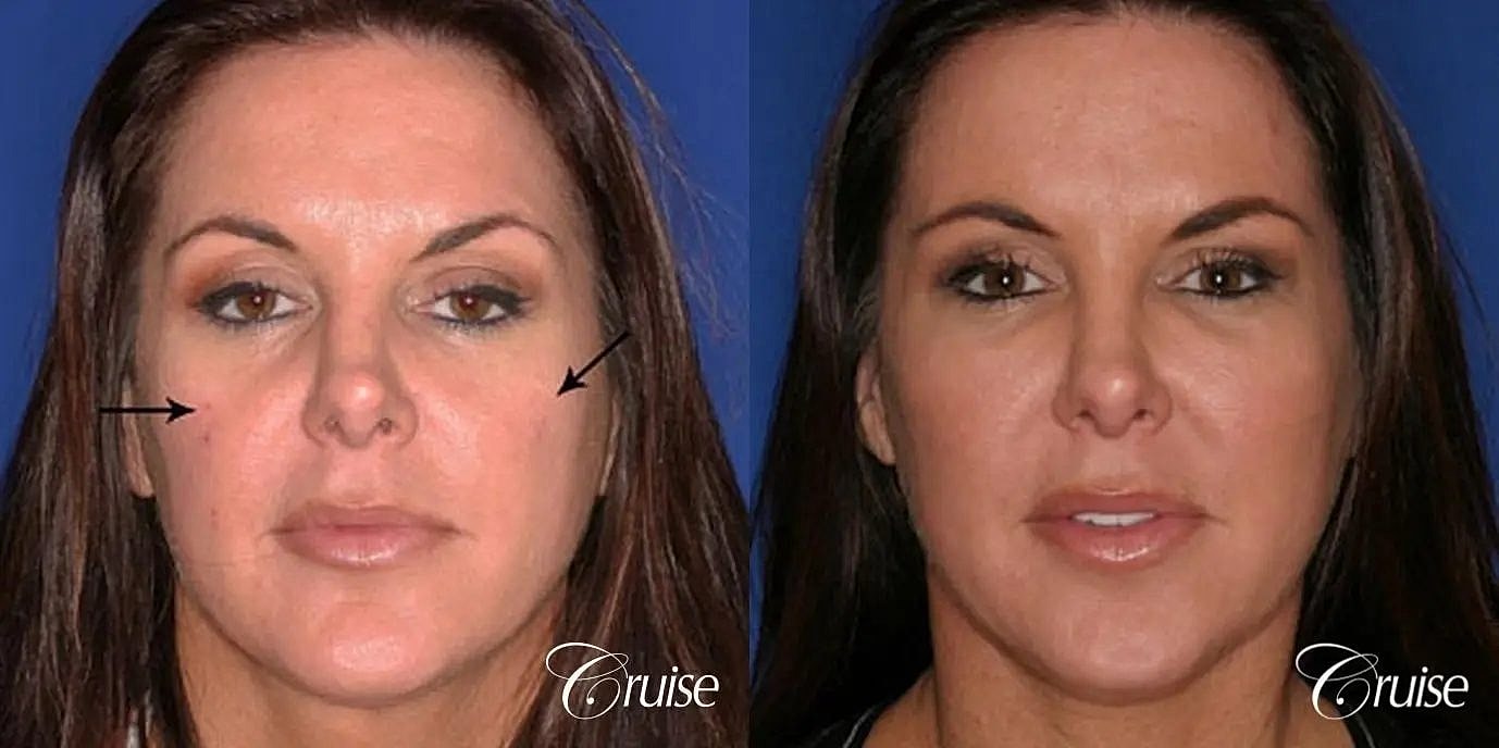 Facial Fat Transfer Before & After