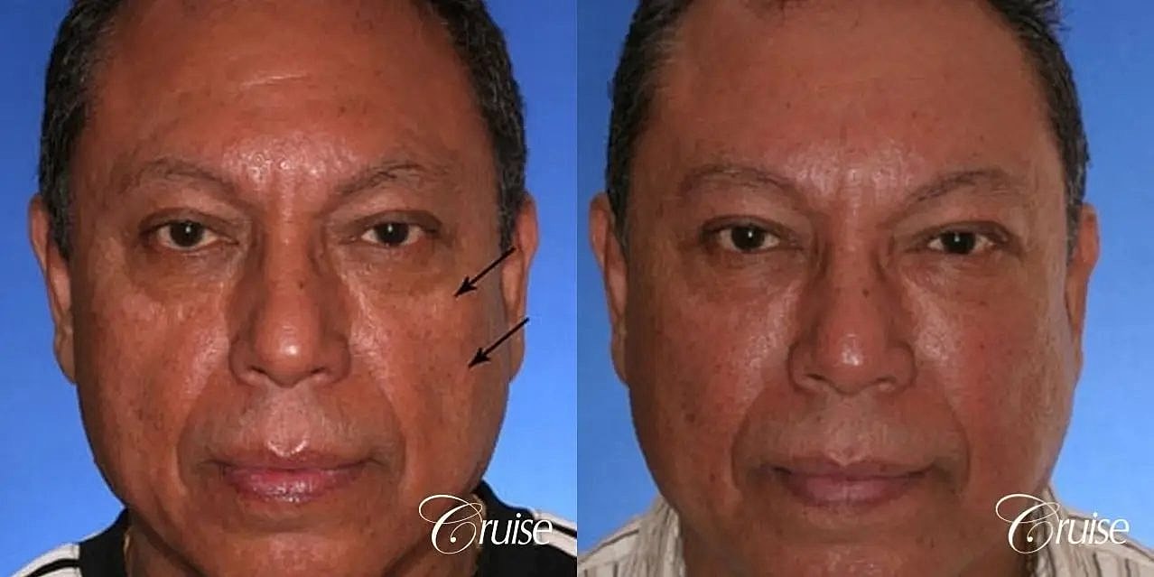 Facial Fat Transfer Before & After