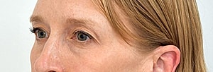 Blepharoplasty Before & After 