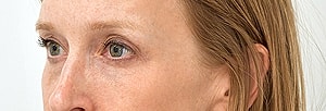 Blepharoplasty Before & After