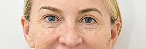 Blepharoplasty Before & After
