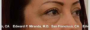 Blepharoplasty Before & After