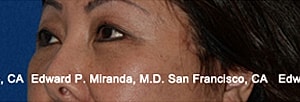 Blepharoplasty Before & After