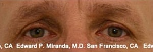 Blepharoplasty Before & After