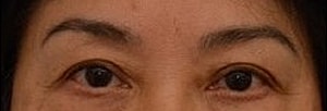 Blepharoplasty Before & After