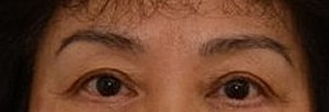 Blepharoplasty Before & After