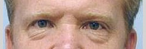 Blepharoplasty Before & After