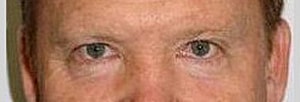 Blepharoplasty Before & After