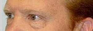Blepharoplasty Before & After