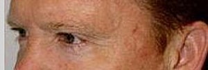 Blepharoplasty Before & After