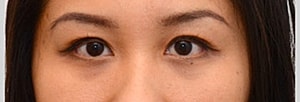 Blepharoplasty Before & After