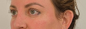 Blepharoplasty Before & After