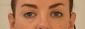 Blepharoplasty Before & After