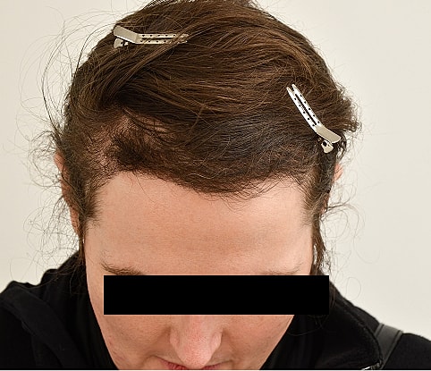 MTF Hair Gallery Before & After