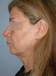 Facelift Before & After