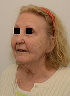 Facelift Before & After