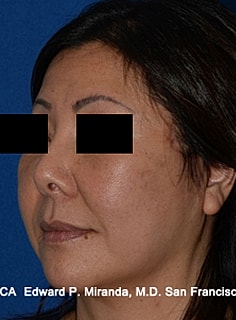Facelift Before & After