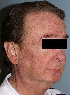 Facelift Before & After