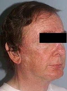 Facelift Before & After