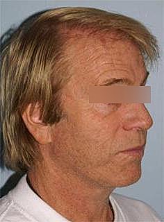Facelift Before & After