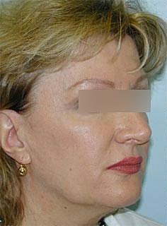 Facelift Before & After