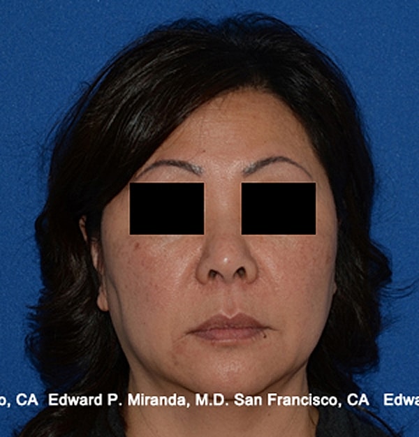 Rhinoplasty Before & After