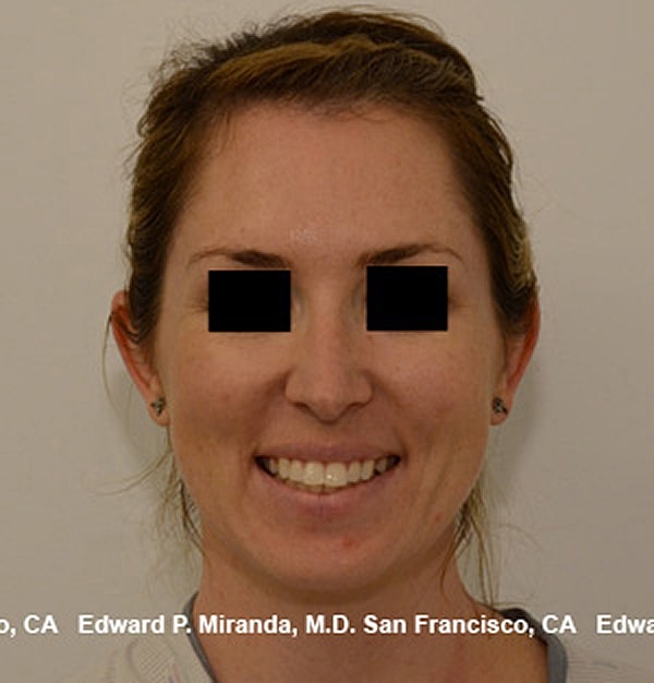 Rhinoplasty Before & After