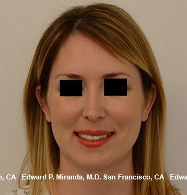 Rhinoplasty Before & After