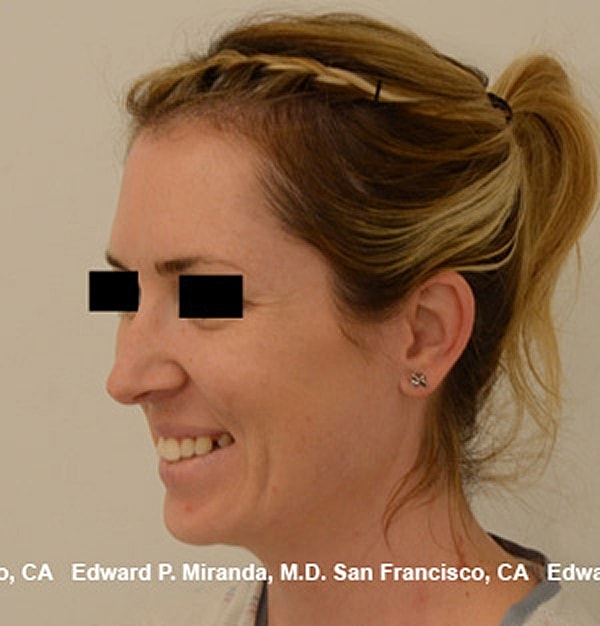 Rhinoplasty Before & After