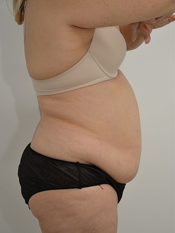 Tummy Tuck Before & After