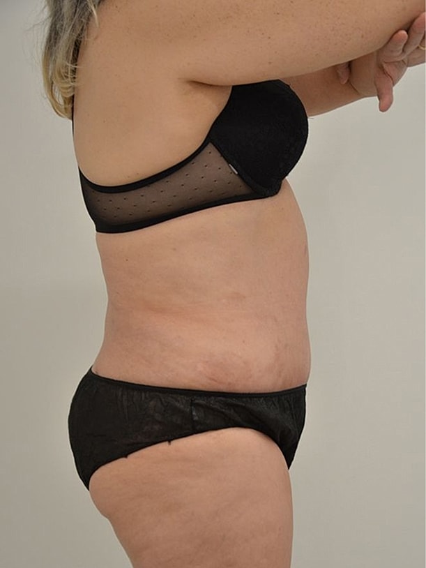 Tummy Tuck Before & After