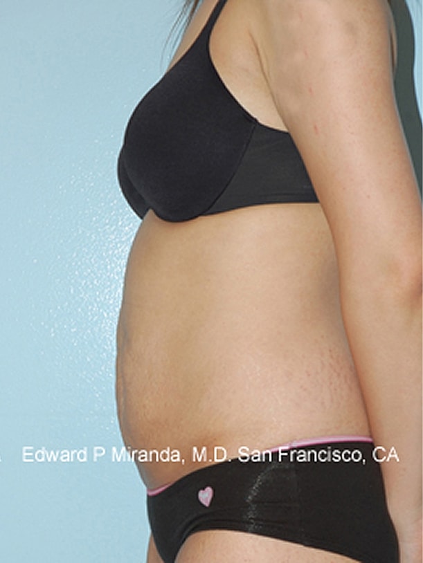 Tummy Tuck Before & After