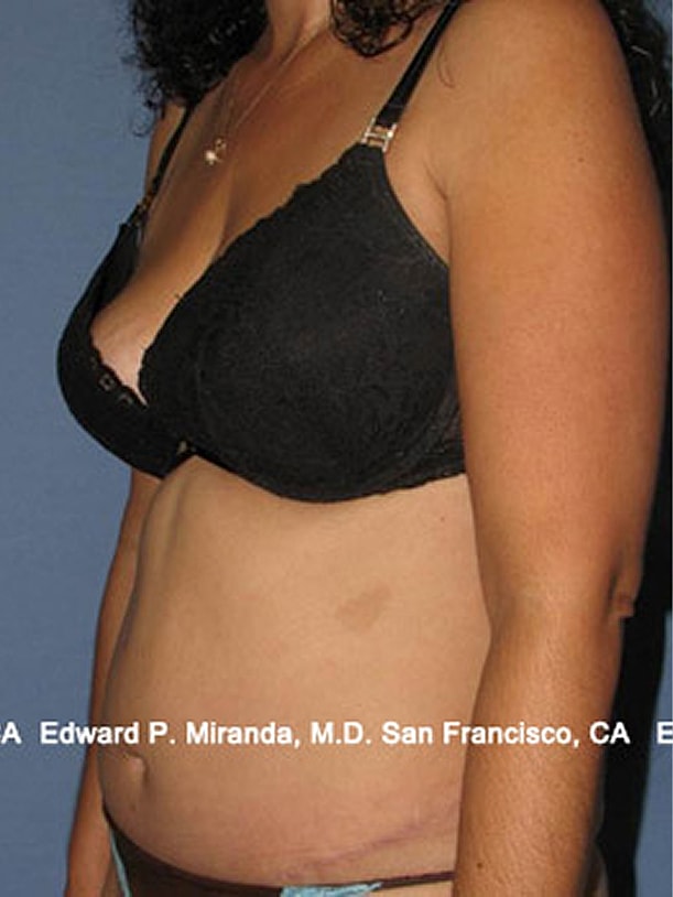 Tummy Tuck Before & After