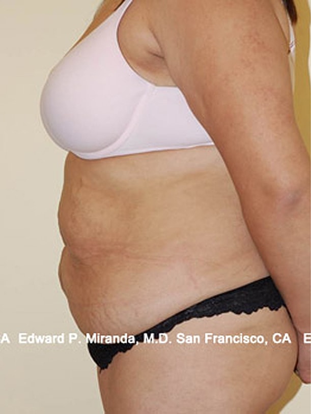Tummy Tuck Before & After