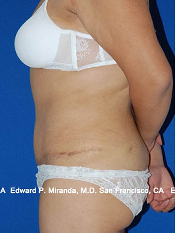 Tummy Tuck Before & After