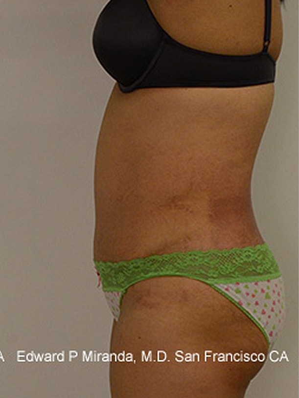 Tummy Tuck Before & After