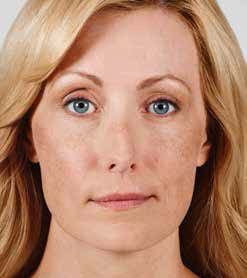 Juvederm Before & After