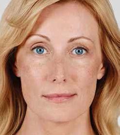 Juvederm Before & After