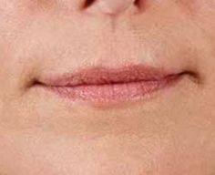 Juvederm Before & After