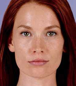Juvederm Before & After