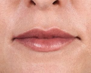 Juvederm Before & After