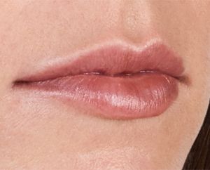 Juvederm Before & After