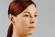 Juvederm Before & After