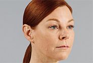 Juvederm Before & After