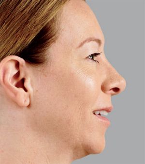 Juvederm Before & After