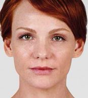 Juvederm Before & After